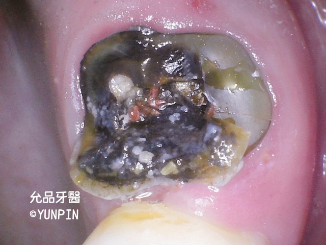 拆除牙套後內部蛀牙情況