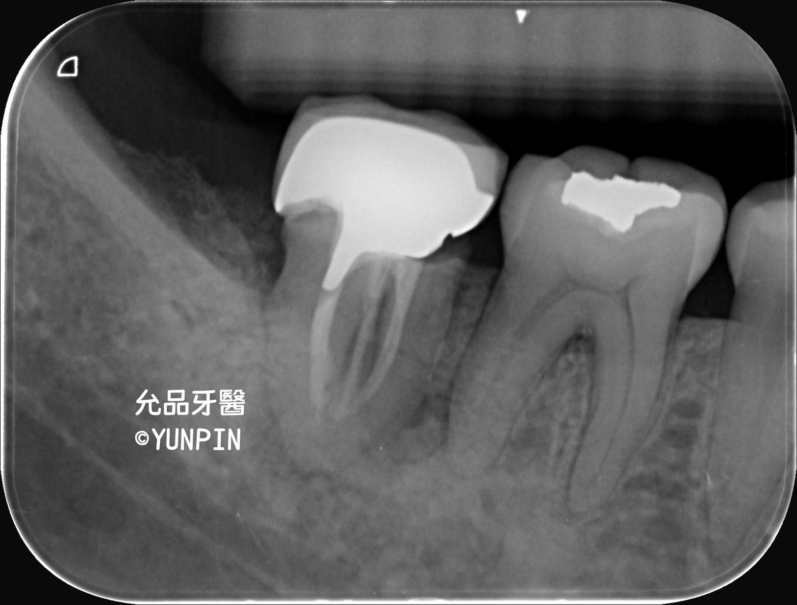 右下第二大臼齒