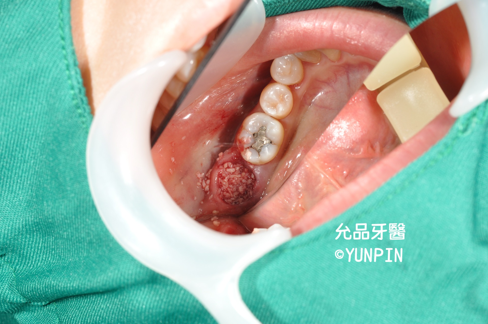 填充骨粉及再生材料